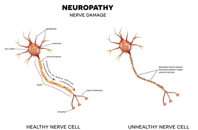 Image showing healthy and damaged nerves. This is showing neuropathy 